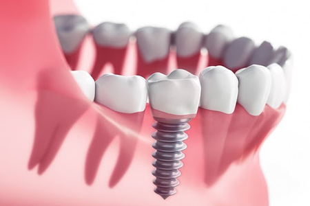 same day dental implant