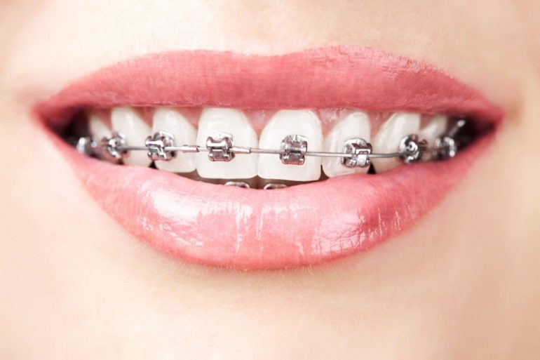 Girl in braces icon