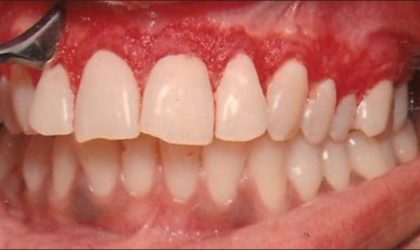 Gum depigmentation