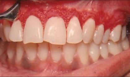 Gum depigmentation