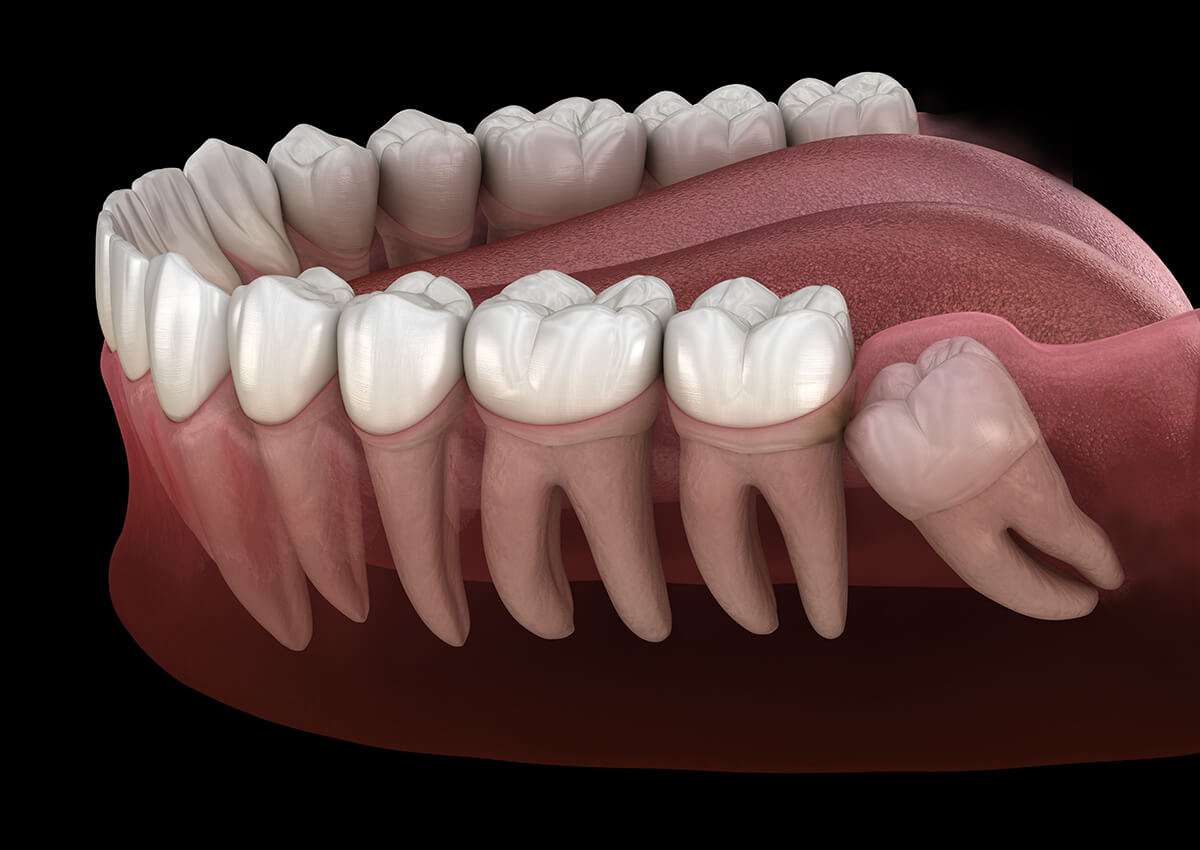 wisdom tooth removal in andheri west