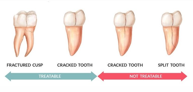 cracked tooth