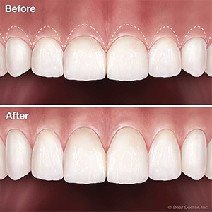 Crown Lengthening