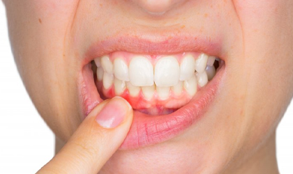 Gum Treatment in Andheri West gum treatment in andheri west